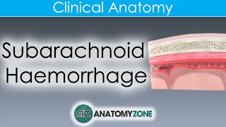 What is Subarachnoid Haemorrhage  Clinical Anatomy [upl. by Oznola]