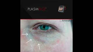 Remove Xanthelasma with Plasmage ®  such a simple and fast operation [upl. by Sirromed]