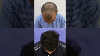 🔥Get Best Hair Transplant Results medlinks shortsfeed shorts [upl. by Eustacia44]