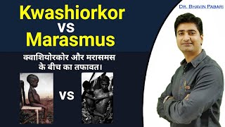 KWASHIORKOR VS MARASMUS difference  Malnutrition disease in child  Full detail in hindi [upl. by Eveleen]