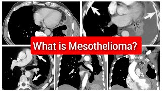 Mesothelioma of Pleura CT Chest [upl. by Ladnyk548]