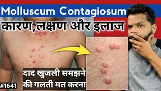 Molluscum Contagiosum Treatment In Hindi  Molluscum Contagiosum Causes And Symptoms [upl. by Drais]