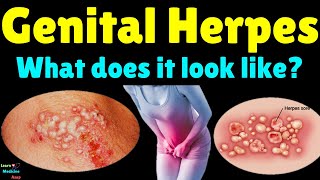 What Does Genital Herpes Look Like  Genital Herpes Signs and Symptoms Treatment and Complications [upl. by Lodge]