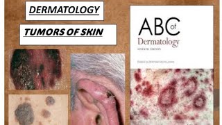 DERMATOLOGY TUMORS OF EPIDERMIS DERMIS amp MELANOCYTES PART2 benign amp malignant derma tumors [upl. by Arob428]