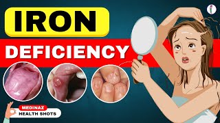 10 Weird Signs Youre Low on Iron  Iron Deficiency Anemia  Iron Deficiency Symptoms [upl. by Ennaharas]