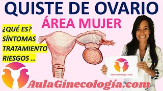 QUISTE DE OVARIO ¿QUÉ ES SÍNTOMAS TRATAMIENTO RIESGOS  Ginecología y Obstetricia [upl. by Stephen711]