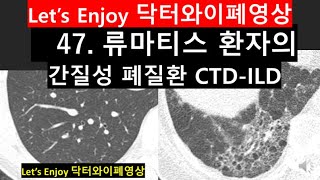 47류마톨로지폐질환류마티스관절염폐질환CTDILD폐섬유증간질성폐질환NSIP비특이성간질성폐렴rheumatologyinlung닥터와이폐영상폐섬유화사진자가면역질환 [upl. by Aymik]