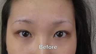 Eyebrow Transplant Amazing Results [upl. by Grethel194]