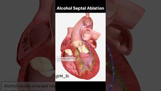 Alcohol Septal Ablation [upl. by Lienahs99]