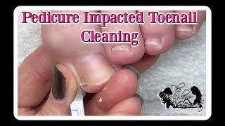 Pedicure How to Clean Impacted Toenails ⭐ [upl. by Adyan]