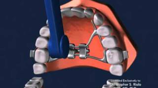 Seattle Orthodontist Dr Christopher Riolo Banded Expander RPE [upl. by Liponis119]