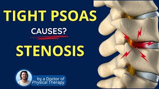 Stenosis Psoas Muscle Tightness amp Lower Back Pain  Causes [upl. by Joelle]