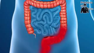 Científicos encuentran causa principal de enfermedad de Crohn y colitis Ulcerosa [upl. by Ebocaj225]