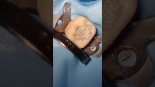 Amalgam Filling Procedure  Step by Step [upl. by Theobald]