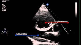 3B Parasternal long axis view of the left ventricle pulmonary hypertension [upl. by Ayenat]