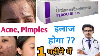 BENZOYL PEROXIDE FOR ACNE ❤️ StepbyStep Guide on HOW TO USE IT Without SIDE EFFECTS [upl. by Aidin494]