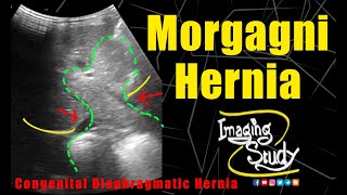 Morgagni Hernia  Congenital Diaphragmatic Hernia  Ultrasound  Case 270 [upl. by Sair438]