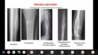 Visioconf  Imagerie  tumeurs osseuses et arthropathies [upl. by Ahsad37]