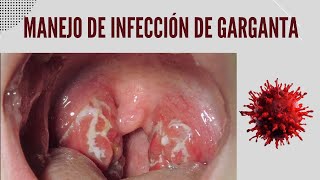 Manejo de la Infección y dolor de garganta [upl. by Ginelle458]