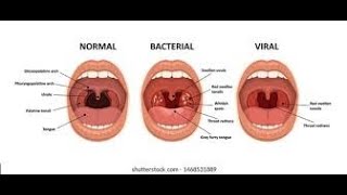 Pharyngitis Part 1 Viral Pharyngitis [upl. by Miche862]