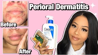 HOW I CLEARED MY PERIORAL DERMATITIS  Affordable Products [upl. by Higginbotham]