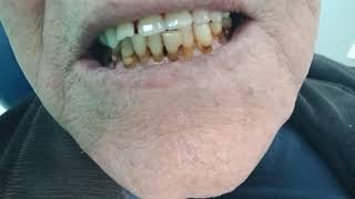 Vist 4 A single upper denture opposing lower natural teeth Avoid incisal guidance [upl. by Ardnassak]