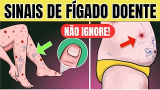 10 SINAIS de PROBLEMA no FÍGADO na PELE  Sintomas de GORDURA NO FÍGADO CIRROSE e HEPATITE [upl. by Iliak]