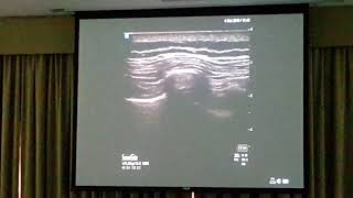 NYSORA Dubai 2019 USG Erector Spinae Plane ESP Block [upl. by Macilroy121]