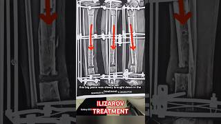 ILIZAROV TREATMENT ilizarovsurgery ytshorts [upl. by Nobie]