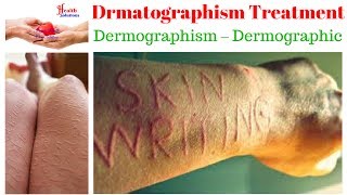 Drmatographism Treatment  Dermographism – Dermographic [upl. by Alberto]