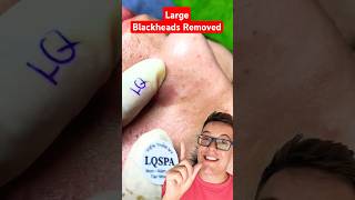 BEST BLACKHEAD REMOVAL 2023  Crazy Satisfying Extraction shorts [upl. by Eifos269]