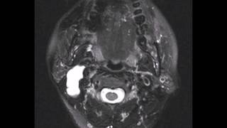 頸部腫塊或囊腫請找耳鼻喉科不是找腫瘤科也不是找一般外 Neck mass or cyst please visit ENT Dr  head amp neck Surgeon [upl. by Knudson]