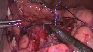 Laparoscopic Cysto Gastrostomy for Pseudocyst Pancreas [upl. by Nanine]