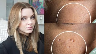 Esthetician Discusses How To Eliminate Pitted Acne Scars [upl. by Buatti]