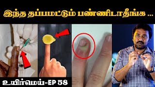 நக சுத்திக்கு சரியான தீர்வு என்ன  Cause and remedy for Nagasuthi  Uyirmei  paronychia [upl. by Rosane]