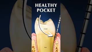 What Is A Gingival Pocket [upl. by Ellevart]