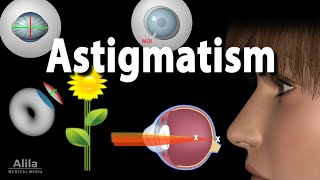 Astigmatism Types Causes Symptoms and Treatment Options Animation [upl. by Anna-Maria]