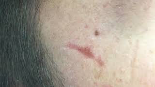 Acne scars subcision [upl. by Ylesara]