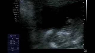 Our Pregnancy 12 weeks 5 days  Nuchal fold scan [upl. by Eerol564]