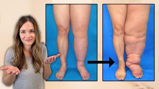 What is Lymphedema [upl. by Hayilaa]