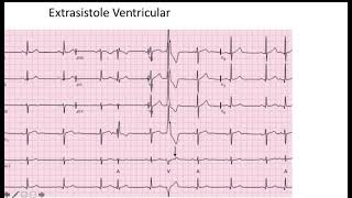 Extrasistole Ventricular EKG [upl. by Ailegnave]