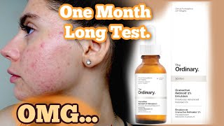 I TESTED THE ORDINARY RETINOID 2 EMULSION SERUM FOR MY ACNE SCARS ONE MONTH  Shocked by this [upl. by Auqinom]