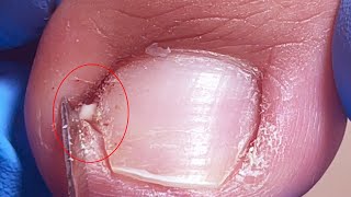 Paronychia causes swelling and pus on the toe remove it quickly [upl. by Dambro810]