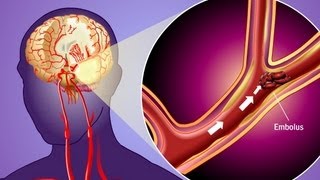 Stroke Prevention amp Transient Ischemic Attack TIA [upl. by Kramal492]