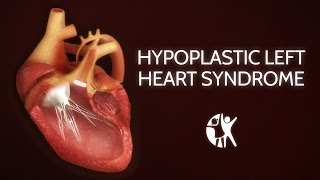 Hypoplastic Left Heart Syndrome HLHS [upl. by Ayikahs]