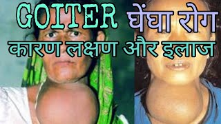 Goiter treatment symptoms cause in hindi [upl. by Olivann346]