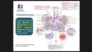 Puntos claves en displasia broncopulmonar [upl. by Anaitit504]