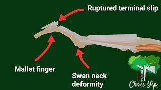 Pathophysiology of Mallet Finger and Swan Neck deformity animated [upl. by Malvin953]