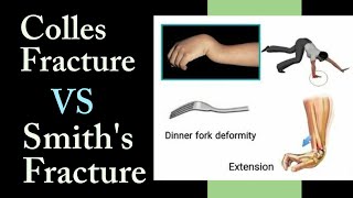 Colles Fracture VS Smiths Fracture II Timesphysio [upl. by Rock]