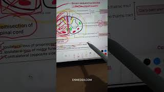 Brown Sequard Syndrome  Neurology inicet neetpg fmge [upl. by Anaitak]